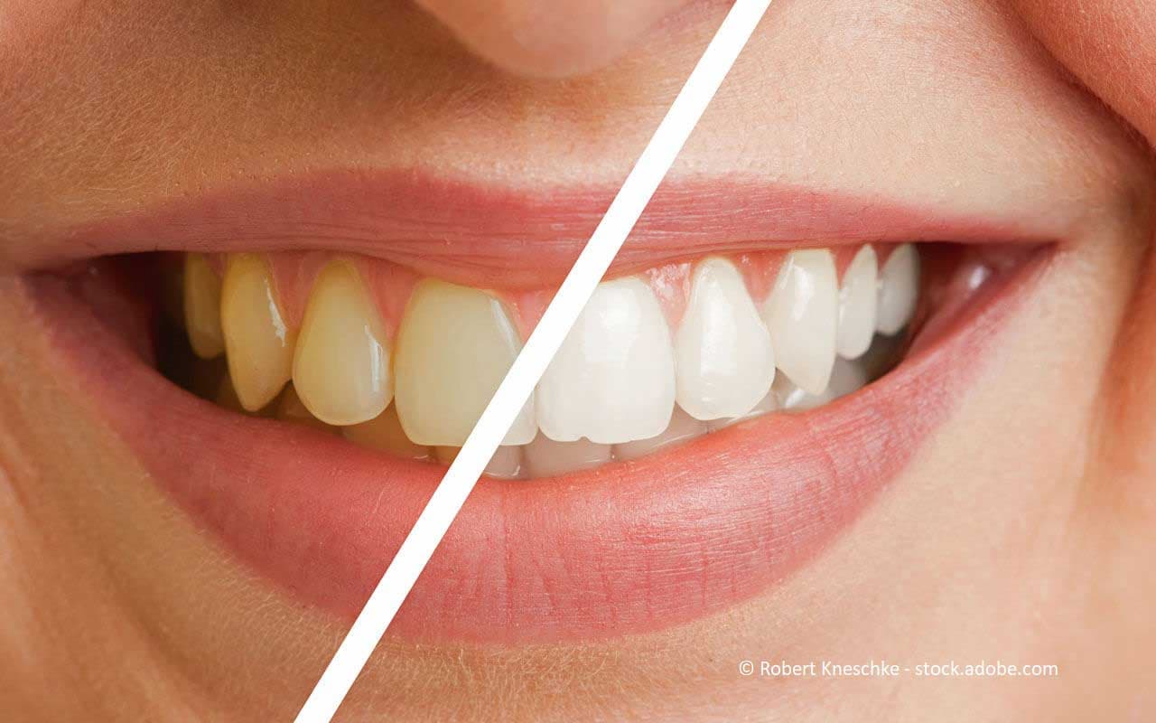Strahlendes Lächeln nach Bleaching-Behandlung