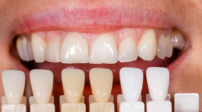 Smile Design und Veneer-Behandlung